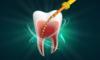Root Canal Preparation
